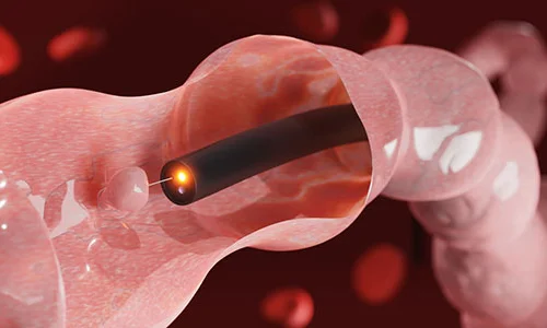 Constipation